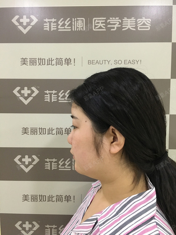 【菲丝澜面部黄金微雕】我是面颊和双下巴同时做的,当时菲丝澜的优惠
