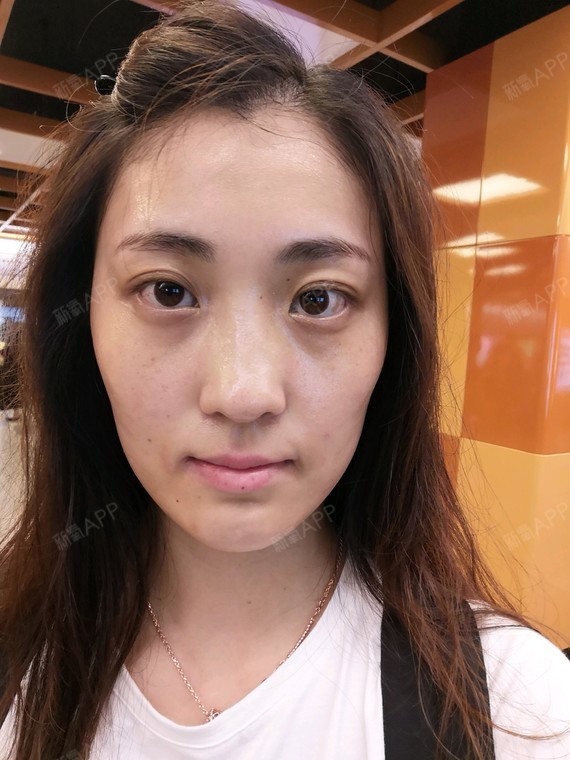 针眼褪掉了皮肤超级滑感觉水润润的