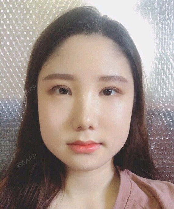 上海埋线双眼皮好不好_效果图_果然人沟通埋线双眼皮3