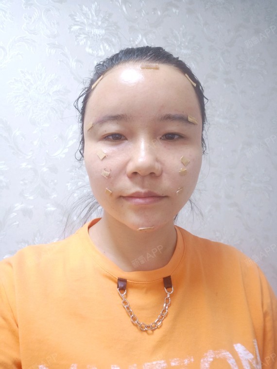 自体脂肪填充额头