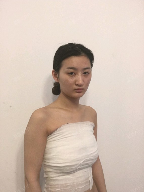 假体隆胸