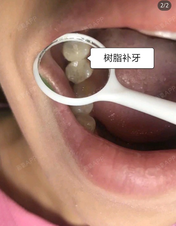 南宁补牙好不好_效果图_氧气3m98b补牙术后第26天