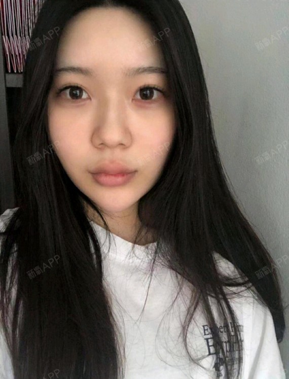 因为我天生鼻子是很塌的,鼻梁可以说是很低,但不是很短,后期打玻尿酸