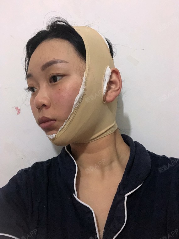 然后我闺蜜圈一个朋友,生完宝宝之后身材变形,就做了吸脂手术,效果