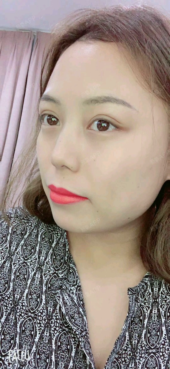 埋线双眼皮好不好_效果图_夏季的雪埋线双眼皮术后第