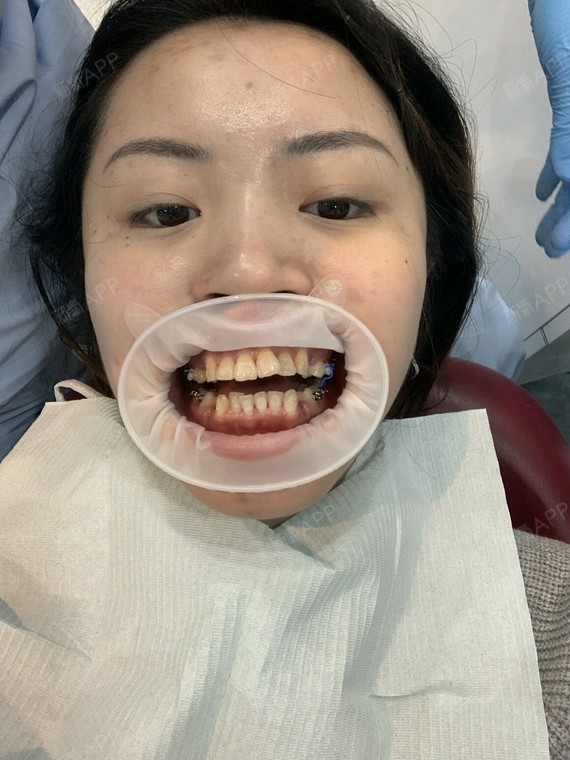 我上排牙齿前突,下排牙不整齐,算是又龅又乱了!拍照