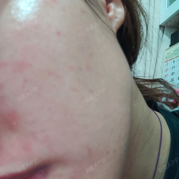 之前在轻伊美打致润动能素,不知道是麻药敷太久还是怎样,过敏了,掉皮