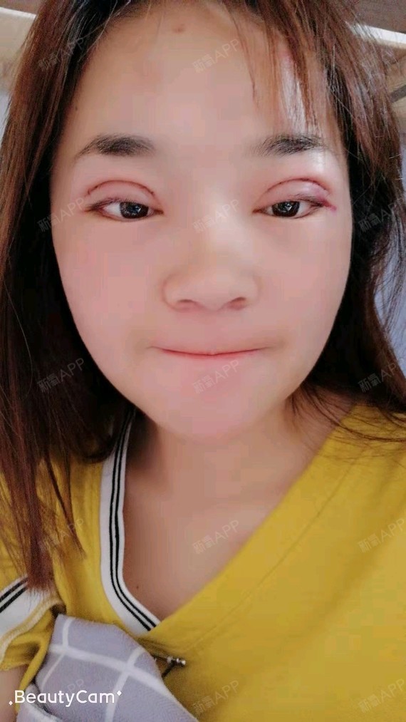 上睑提肌