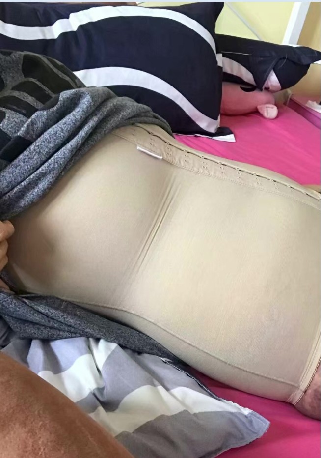 吸脂瘦腹部第20天