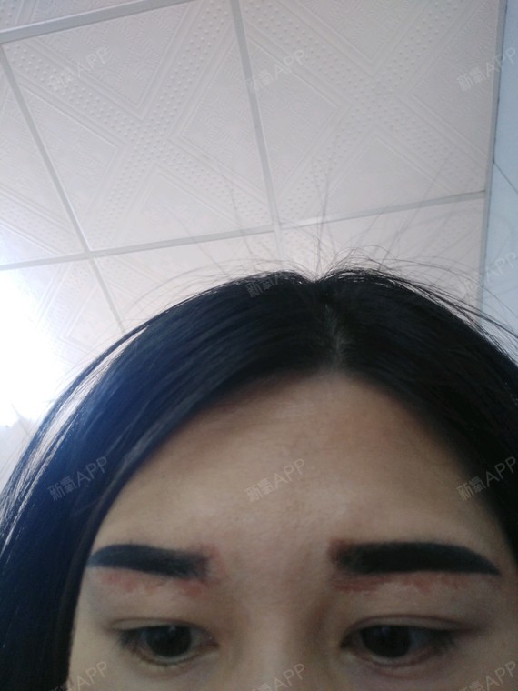 半永久纹眉项目术后第3天 结痂第二天,感觉旁边电伤的地方还是很严重
