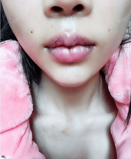 m唇手术