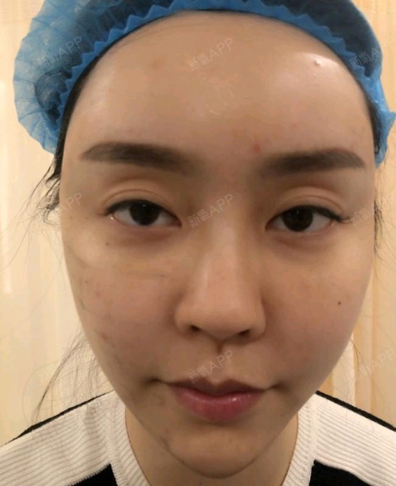 做了全脸哦,热玛吉,第五代,紧致度非常高