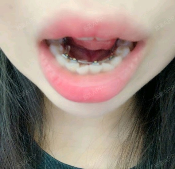 因为我的下排前端牙齿长得很不整齐,所以这回就只是做