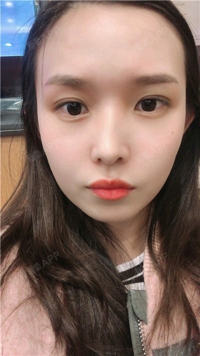 埋线双眼皮