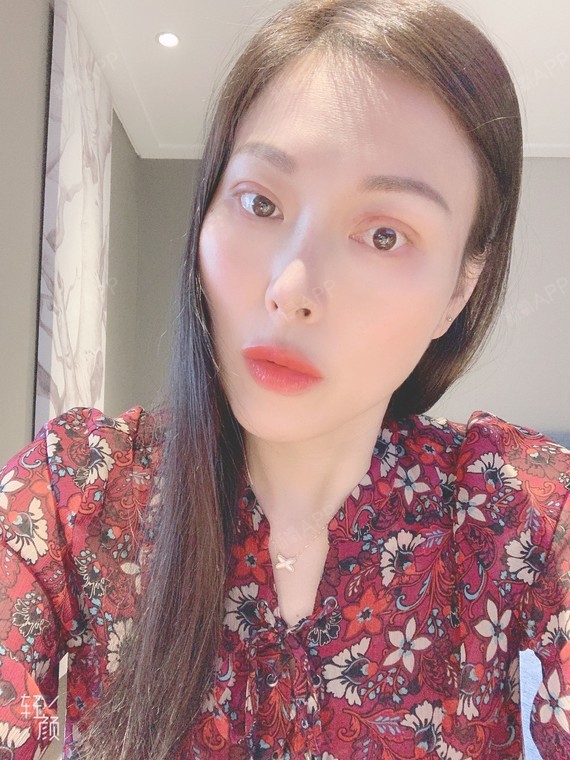 埋线双眼皮好不好_效果图_悠如风埋线双眼皮术后第26