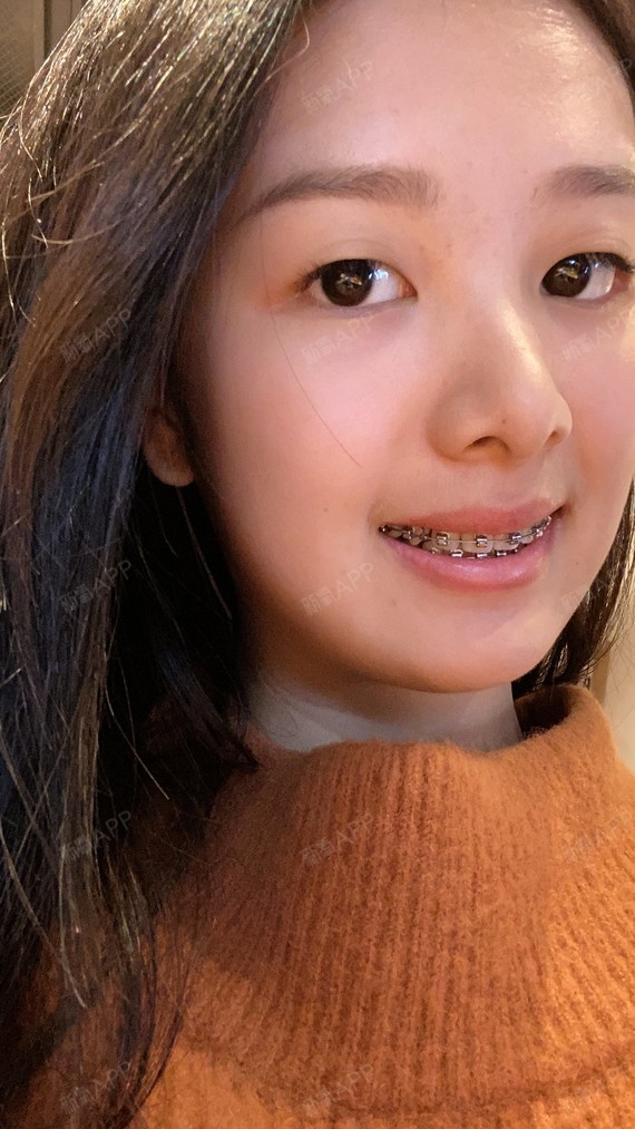 效果更明显了,基本上每周都能看到变化,坚持坚持争取今年摘牙套啦