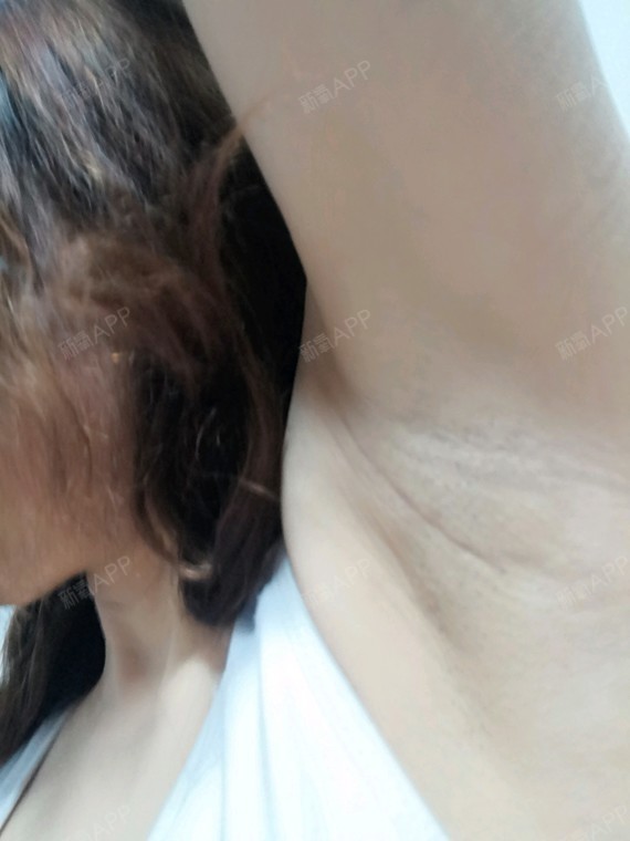 假体隆胸