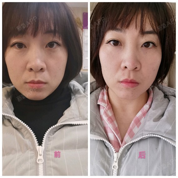 真的一点效果都没有! 上传一张手术当天照片和今天的照片对比