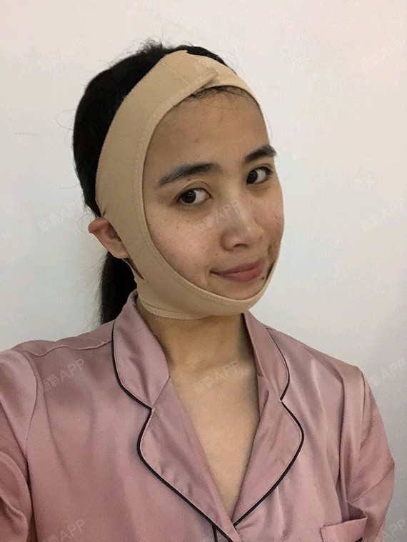 深圳光纤溶脂瘦脸好不好_效果图_羞涩喵小猫光纤溶脂3