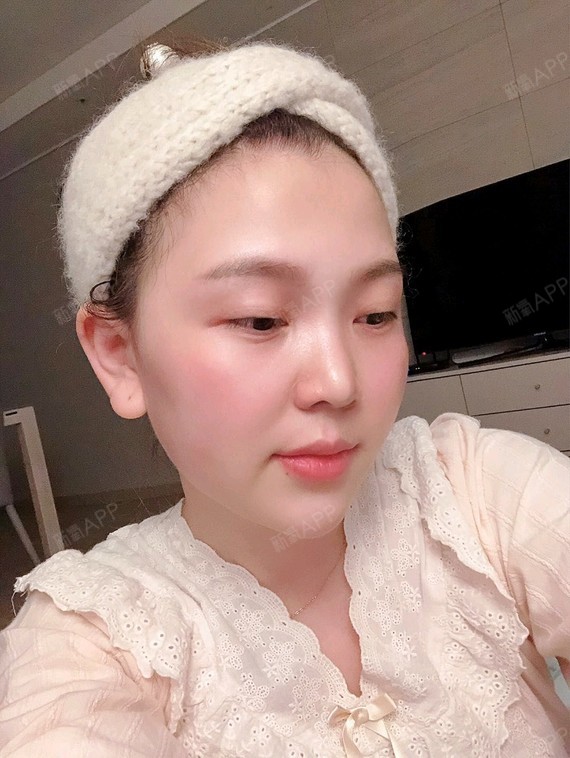 深圳光纤溶脂瘦脸好不好_效果图_小仙女青青光纤溶脂7
