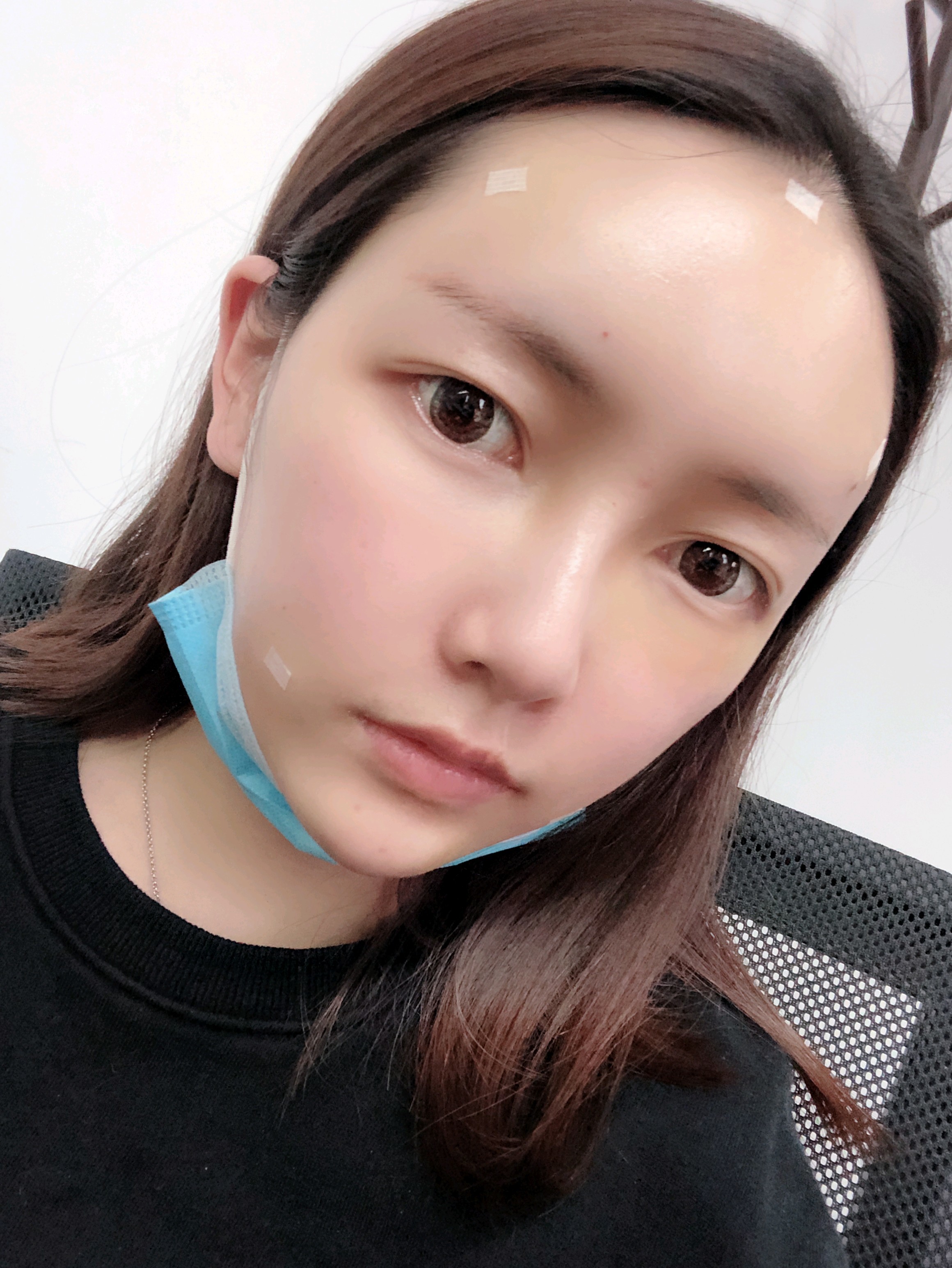 自体脂肪全脸填充第3天