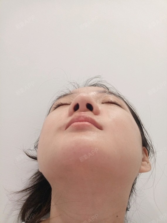 v-line瓜子脸手术
