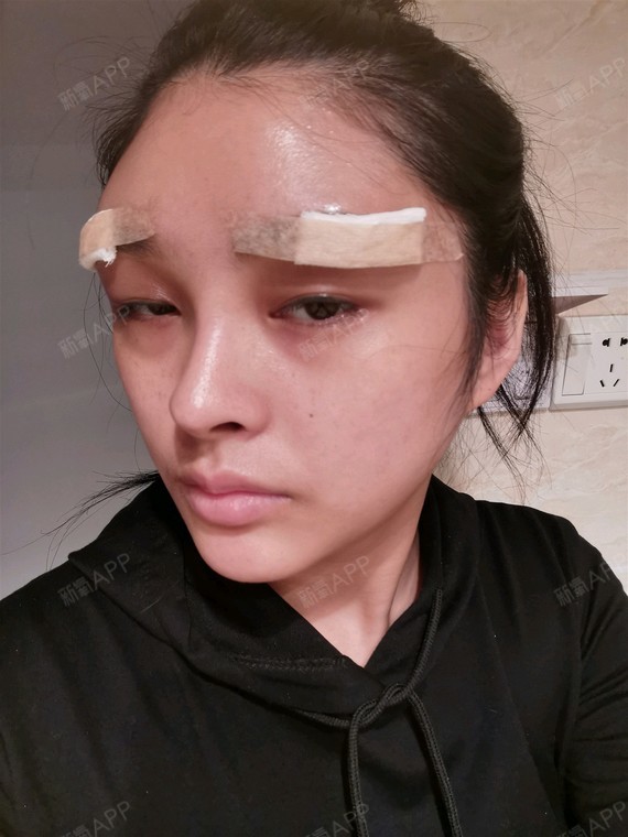 假体垫眉弓