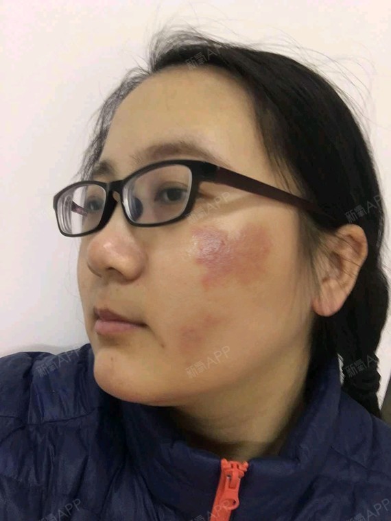激光去胎记