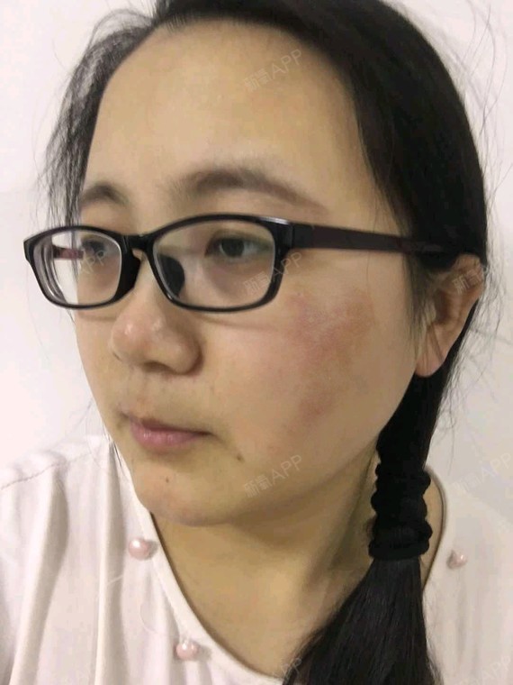 激光去胎记好不好_效果图_快乐肥皂水激光去胎记术后
