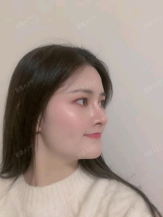 肋软骨隆鼻