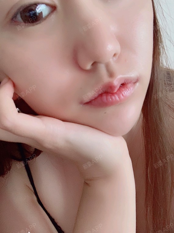 m唇手术