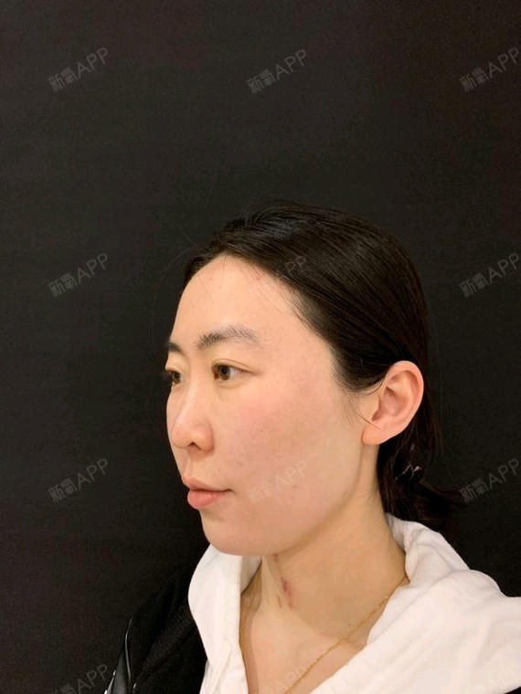 北京面部吸脂好不好_效果图_婷宝baby面部吸脂术后第1