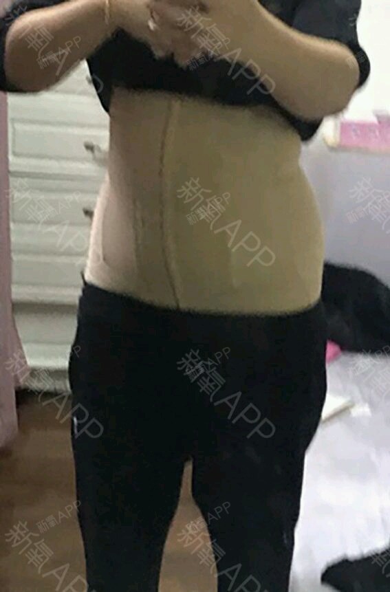 吸脂瘦腹部