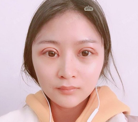 很庆幸我做了眼睛之后没有充血呢,肿胀的可能厉害,毕竟是第