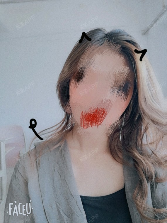 上海比基尼线脱毛好不好_效果图_氧气1a0sk比基尼线术