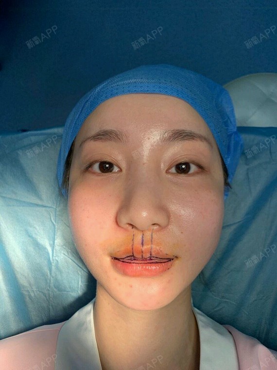 m唇手术