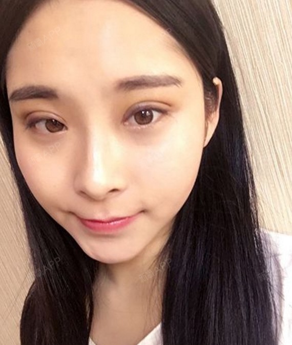 大连埋线双眼皮好不好_效果图_氧气l0dsx埋线双眼皮术
