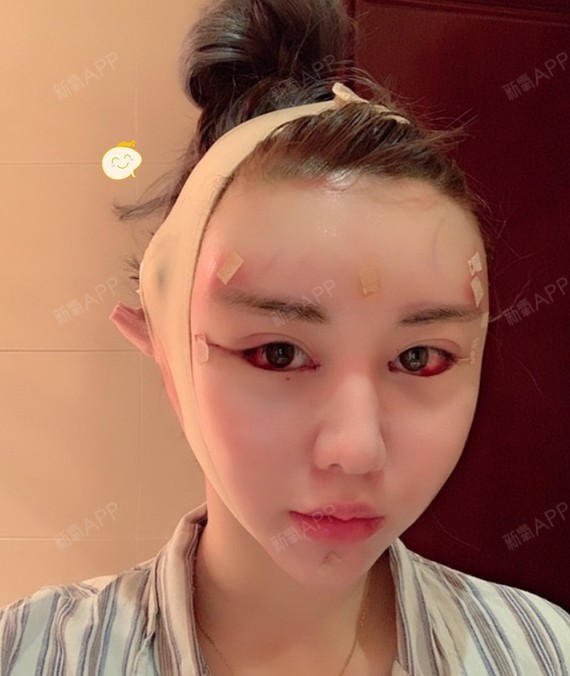 成都面部吸脂好不好_效果图_氧气m6197面部吸脂术后第