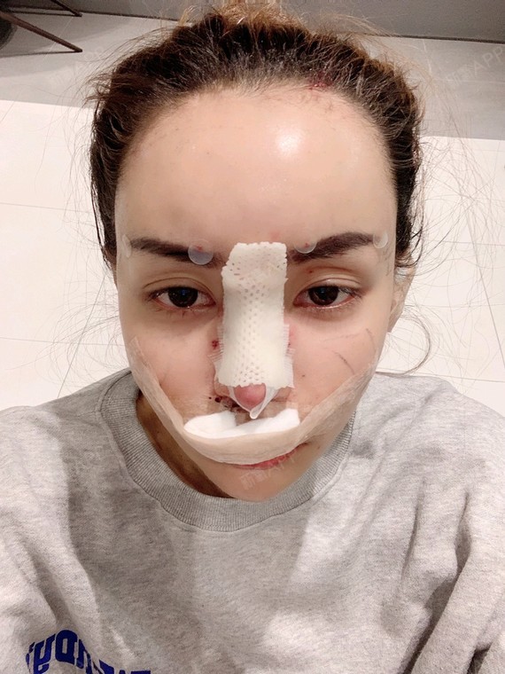 超体隆鼻