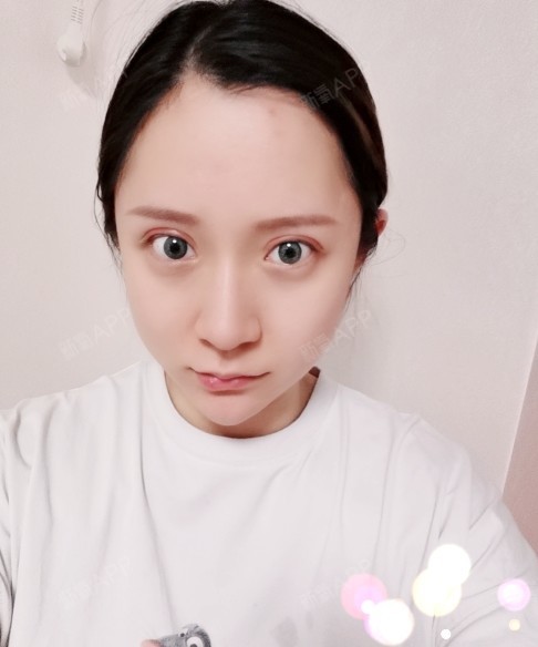 人中缩短术