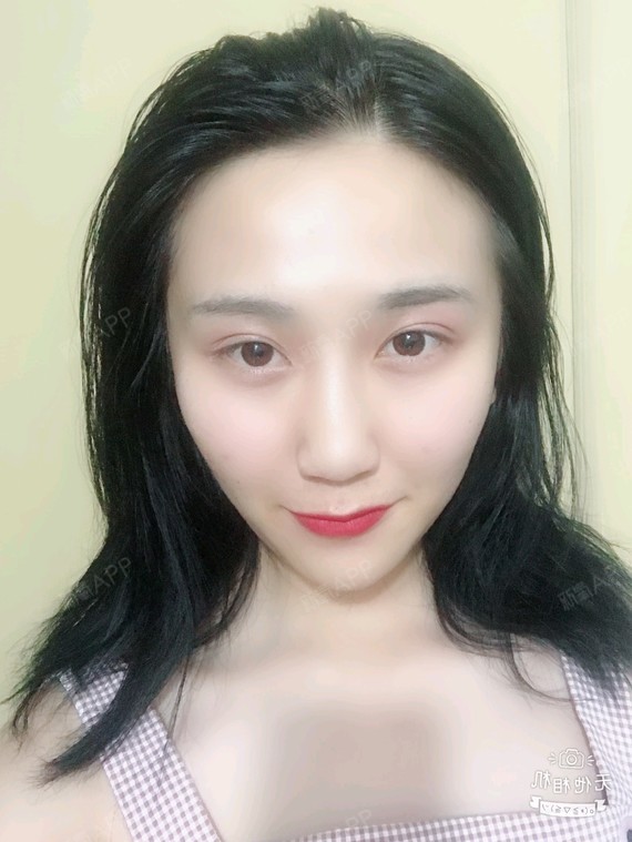 佛山埋线双眼皮好不好_效果图_氧气fndjp埋线双眼皮术