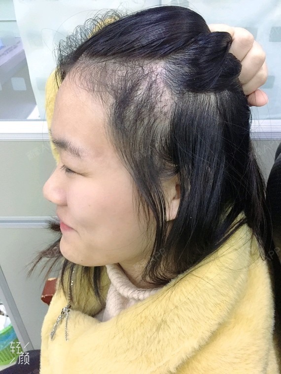 现在感觉完全好了,撩开头发看就好像是剪了一点小碎发