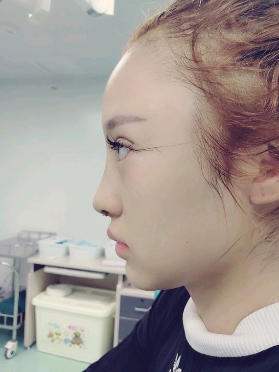 之前埋线考虑好久然后咨询医生还是把眼睛修复