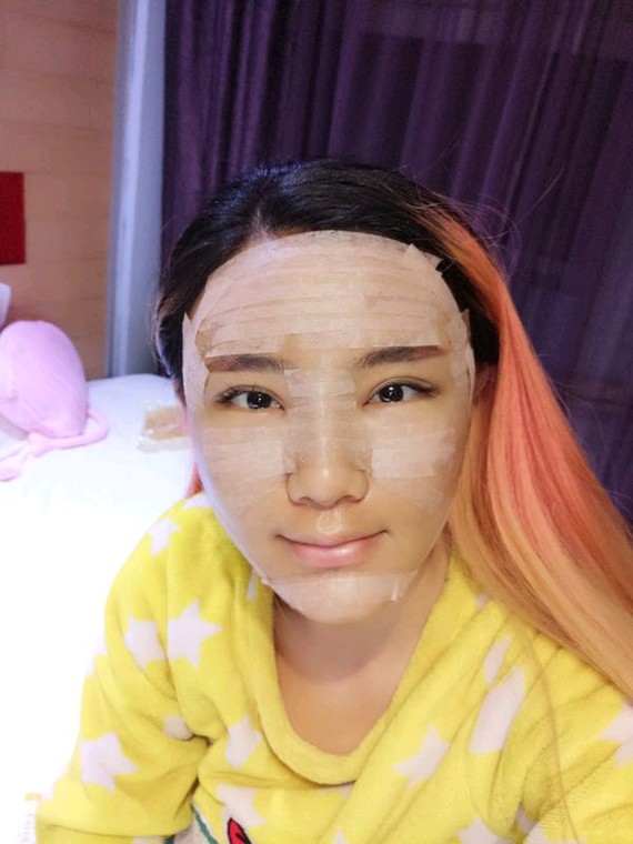 亲一草自体脂肪全脸填充第4天美丽日记-新氧美