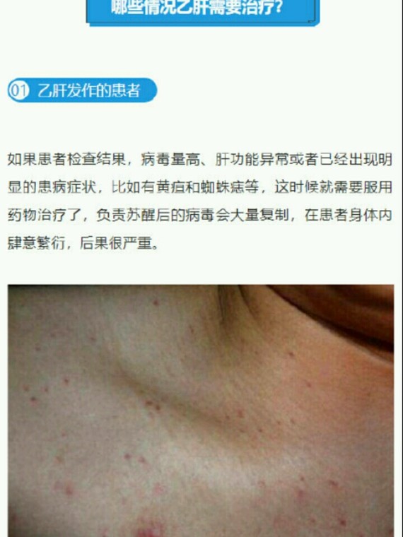 乙肝是不能割双眼皮,乙肝炎并不_圈子-新氧美容整形