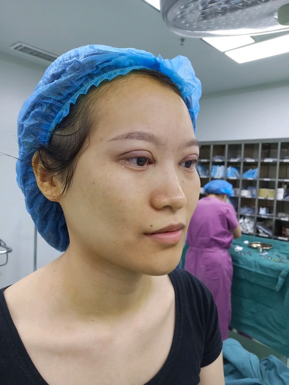 Q1:双眼皮手术伤口完全恢复要多久?双眼皮一