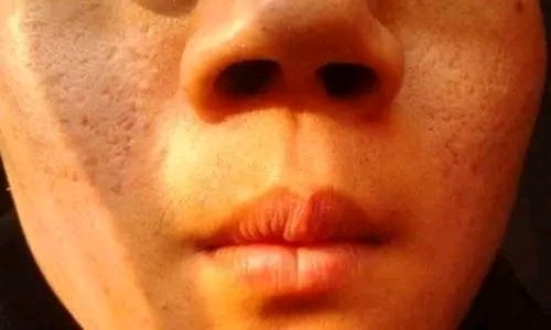 痘坑可以做什么项目