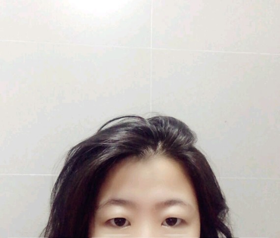 肿眼泡怎么做双眼皮?切开双眼皮手术是在上眼