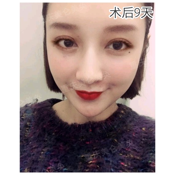 上眼窝凹陷好老气怎么办?这样做让你年轻十岁