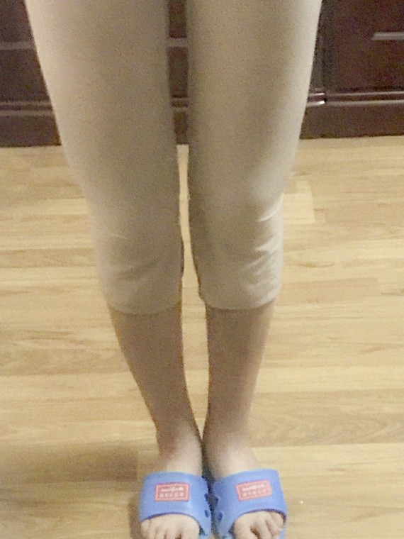我的第一次医美是就是前几天在北京达美如艺做的腿型矫正了.